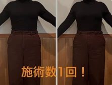 脂肪溶解施術1回の変化。30代女性の正面からのビフォーアフター。