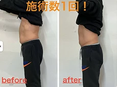 : 脂肪溶解施術1回の変化。50代男性のウエストラインのビフォーアフター。